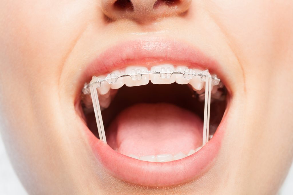 clear braces, clear braces in New Hope and Chanhassen